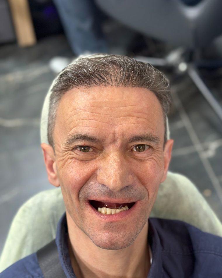 Before: missing and failing upper teeth