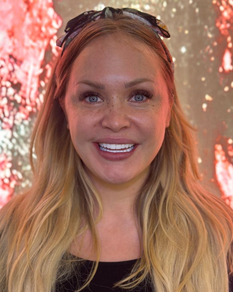 After: Hollywood Smile veneer makeover