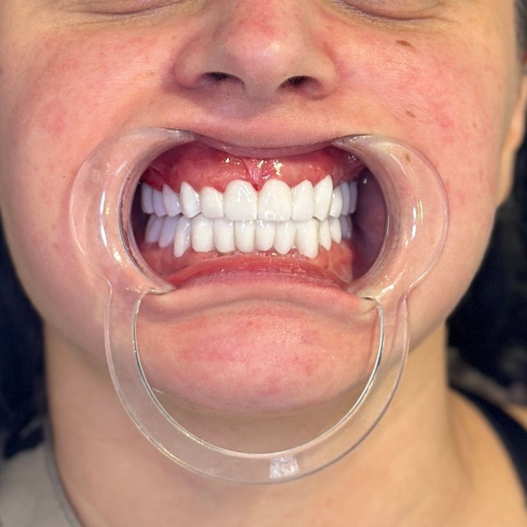 After: full smile makeover with new crowns