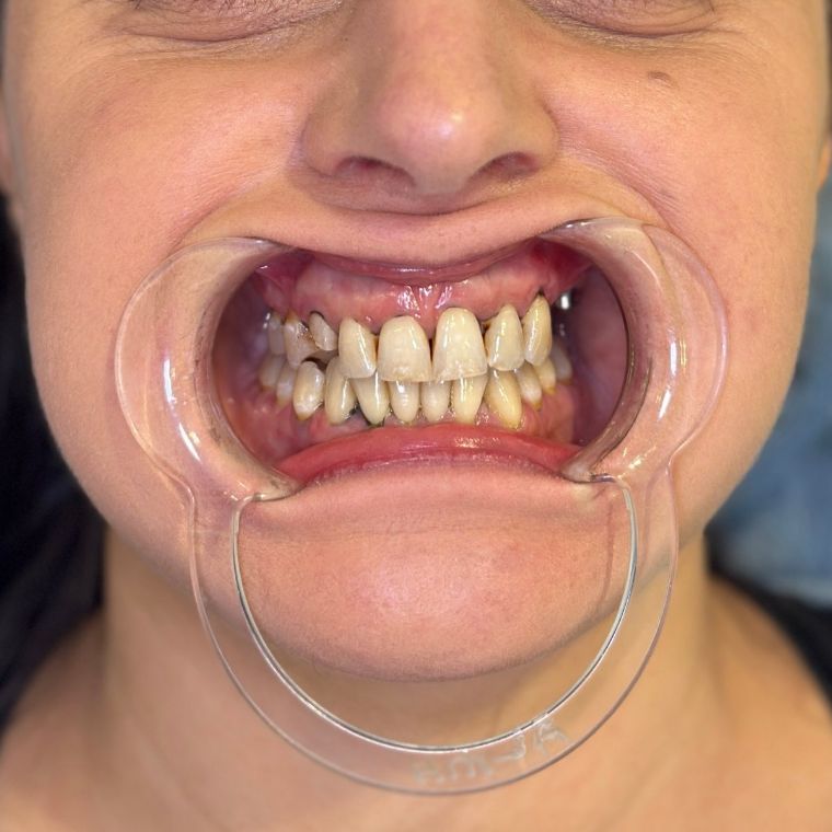 Before: discoloured and crowded teeth
