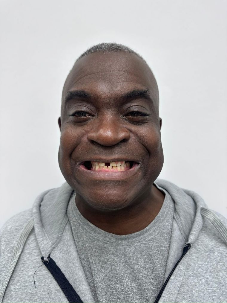 Before: worn and missing upper and lower teeth