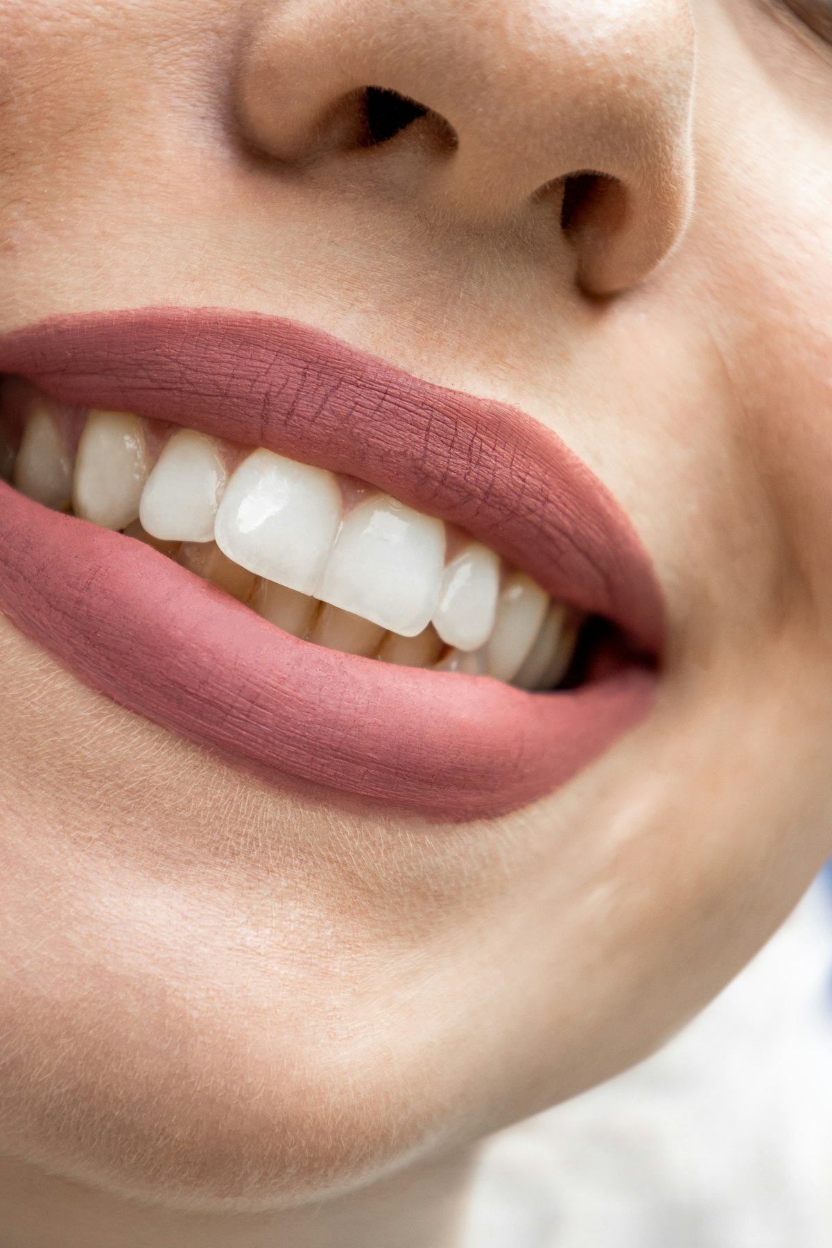Composite Veneers in Turkey