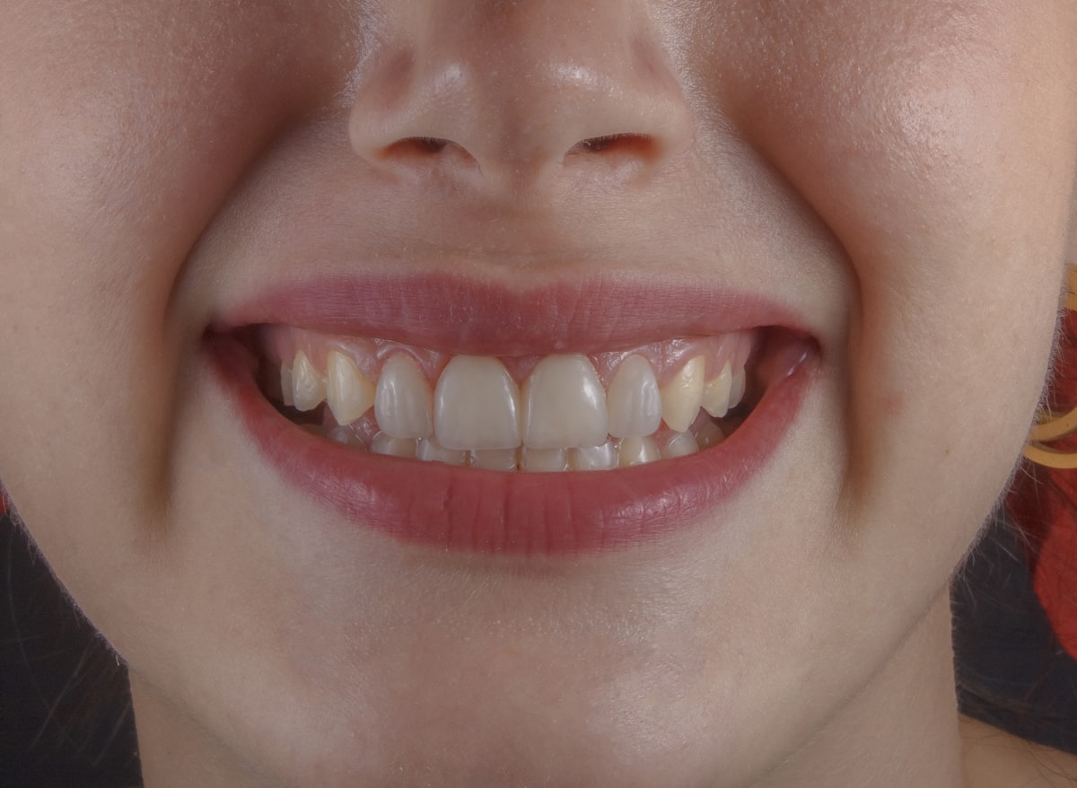 Teeth Whitening in Turkey