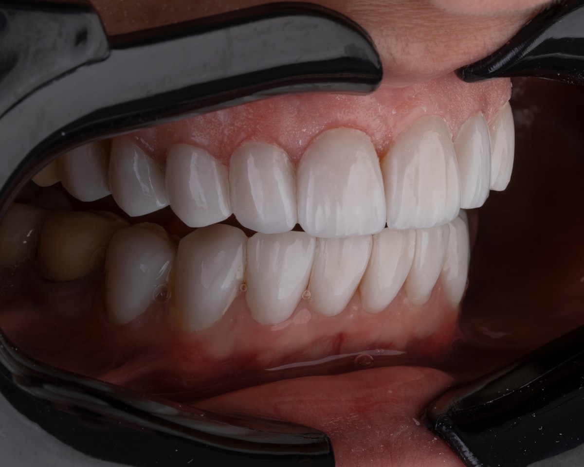 E-max Veneers in Turkey